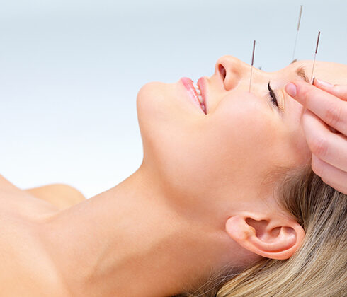 Acupuncture facial rejuvenation
