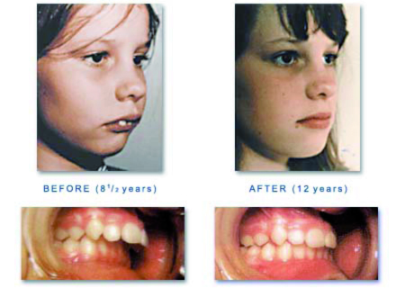 buteyko before and after buteyko before and after