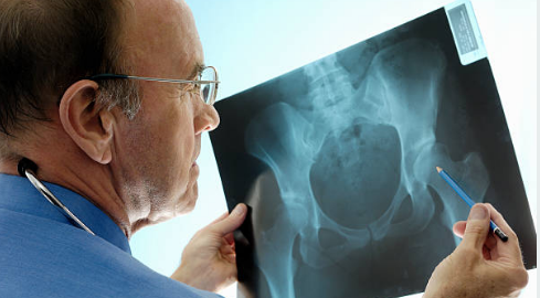 osteoporosis